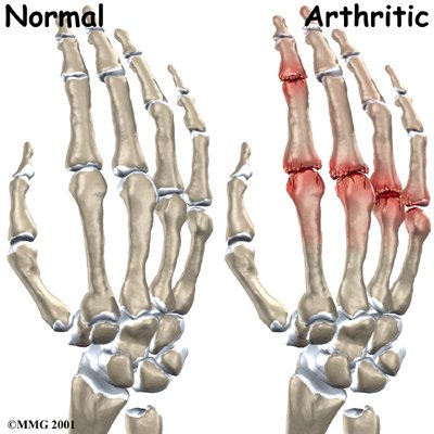 hand_finger_joint_causes01-719508